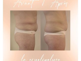 Cryolipolyse avant et après - 853035