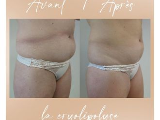 Cryolipolyse avant et après - 853036