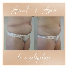 Cryolipolyse - Dr Nawel Sarouti-Lungo