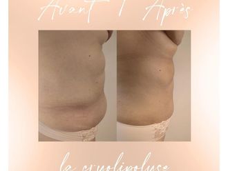 Cryolipolyse avant et après - 853043