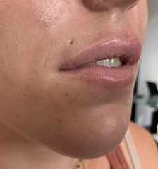 injection des lèvres après 