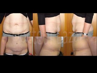 Avant après Abdominoplastie esthétique