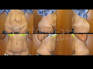 Avant après Abdominoplastie réparatrice post chirurgie de l'amaigrissement