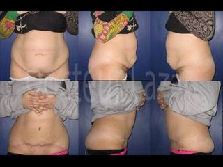 Avant après Abdominoplastie