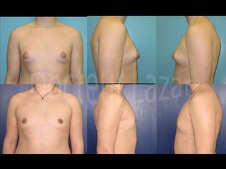 Avant après Gynecomastie