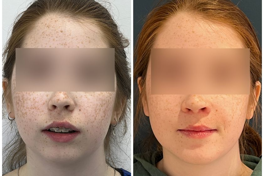 Chirurgie maxillo-faciale avant et après - 867576
