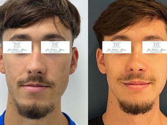 Chirurgie maxillo-faciale avant et après - 876433