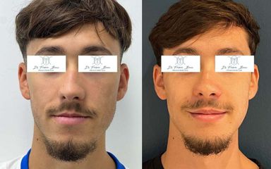 rhinoplastie genioplastie Dr Frédéric Barère