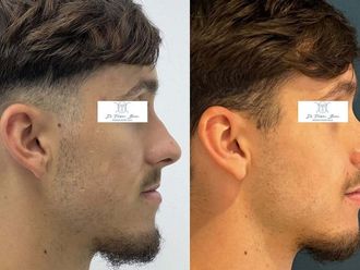 Chirurgie maxillo-faciale avant et après - 876434