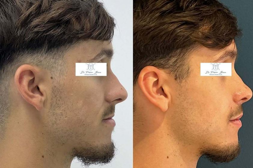 Chirurgie maxillo-faciale avant et après - 876434