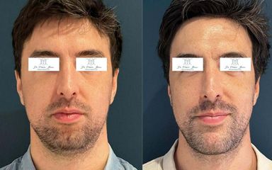 Genioplastie Dr Frédéric Barère