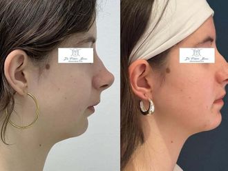 Chirurgie maxillo-faciale avant et après - 876927