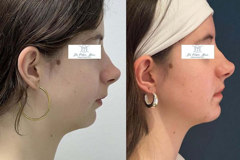 Chirurgie maxillo-faciale avant et après - 876927