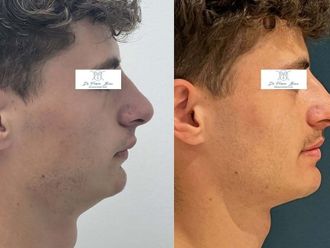 Chirurgie maxillo-faciale avant et après - 876928