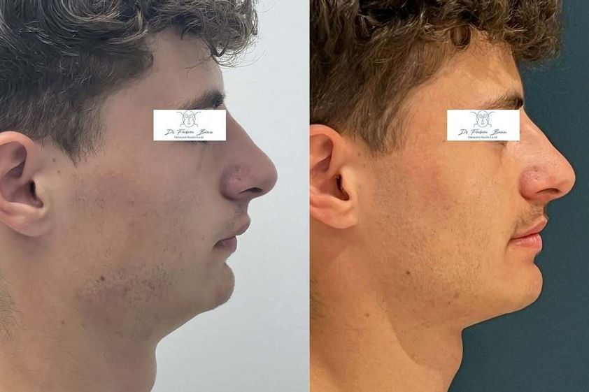 Chirurgie maxillo-faciale avant et après - 876928