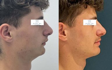 ostéotomie avancée mandibulaire Dr Frédéric Barère