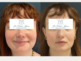 Rhinoplastie avant et après - 876929