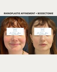 rhinoplastie et bossectomie Dr Frédéric Barère