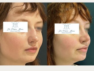 Rhinoplastie avant et après - 876930