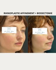 Rhinoplastie y Bossectomie - Dr Frédéric Barère