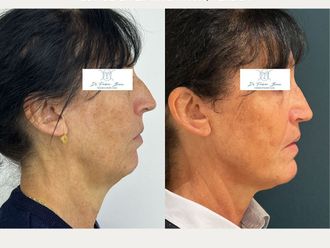 Chirurgie maxillo-faciale avant et après - 876931