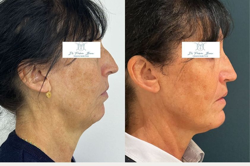 Chirurgie maxillo-faciale avant et après - 876931