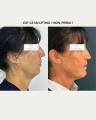 ostéotomie bimaxillaire de projection Dr Frédéric Barère