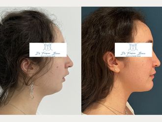 Chirurgie maxillo-faciale avant et après - 878042