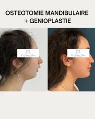 OSTEOTOMIE BIMAXILLAIRE + GENIOPLASTIE Dr Frédéric Barère