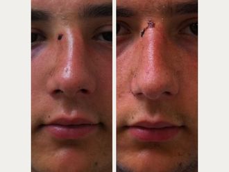 Rhinoplastie avant et après - 878044