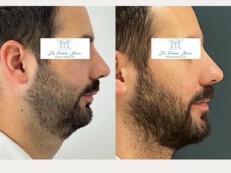 Chirurgie maxillo-faciale avant et après - 878045