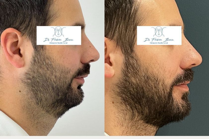 Chirurgie maxillo-faciale avant et après - 878045