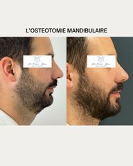 OSTEOTOMIE MANDIBULAIRE Dr Frédéric Barère