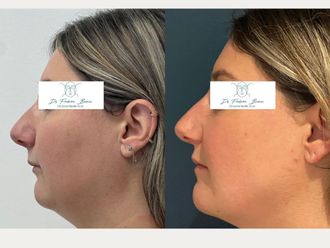 Chirurgie maxillo-faciale avant et après - 878046