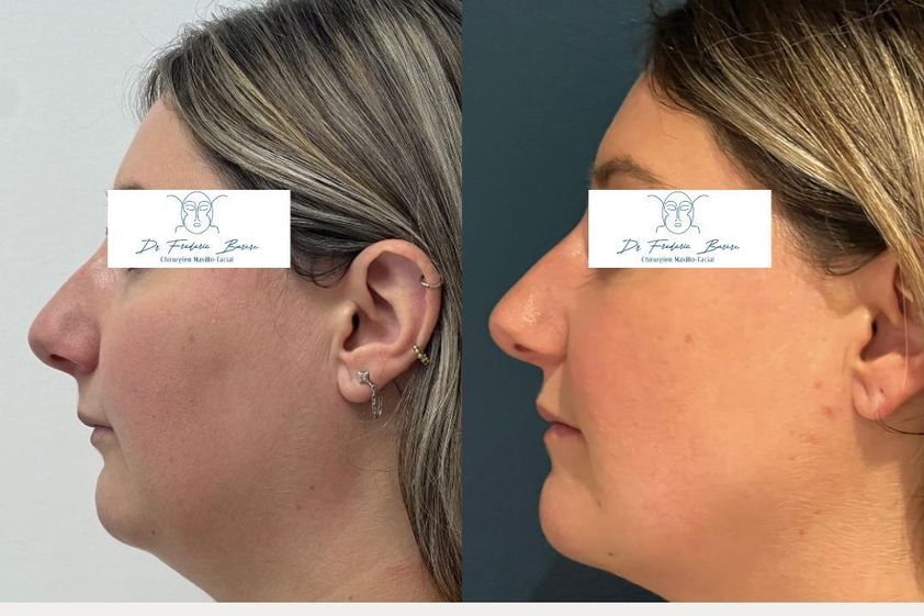Chirurgie maxillo-faciale avant et après - 878046