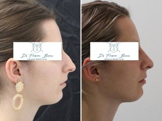 Rhinoplastie avant et après - 878578