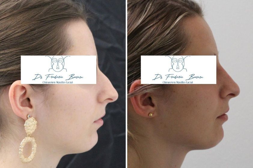 Rhinoplastie avant et après - 878578