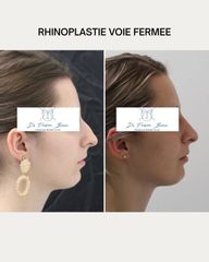 Rhinoplastie