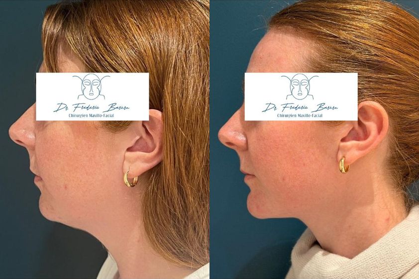 Génioplastie avant et après - 879418