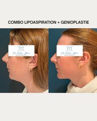 COMBO LIPOASPIRATION + GENIOPLASTIE