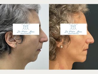 Génioplastie avant et après - 879419