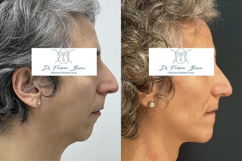 Génioplastie avant et après - 879419