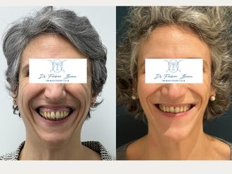 Génioplastie avant et après - 879420
