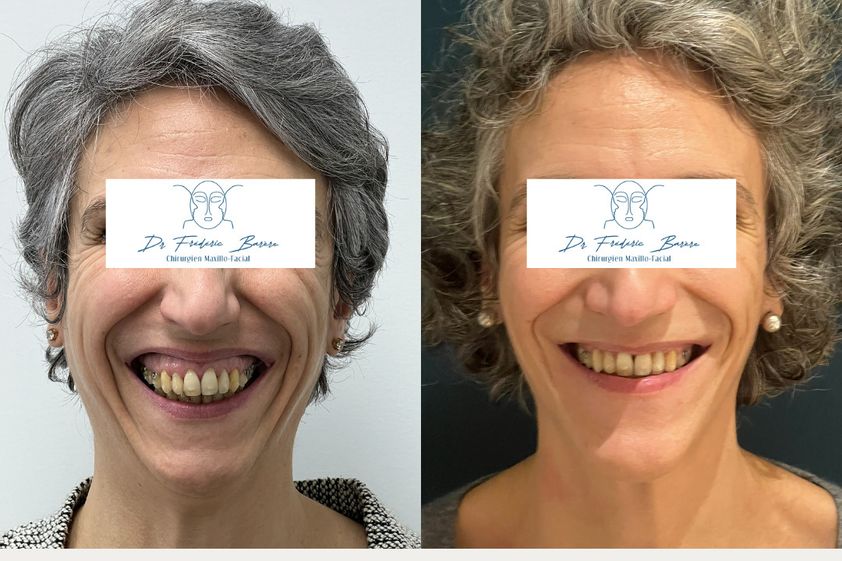 Génioplastie avant et après - 879420