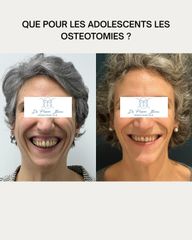 OSTEOTOMIES