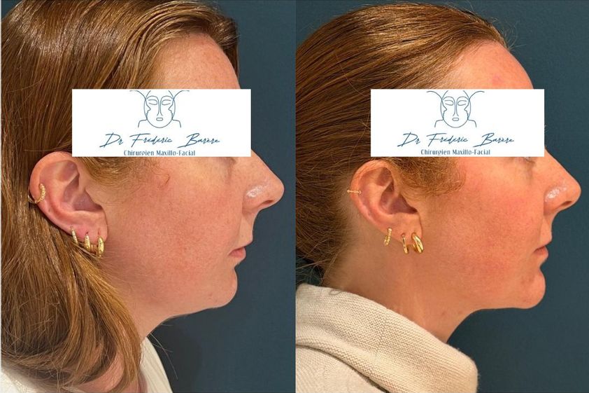 Génioplastie avant et après - 879954