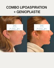 génioplastie par ostéotomie et lipoaspiration Dr Barere