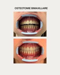 OSTEOTOMIE BIMAXILLAIRE Dr Barere