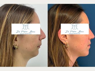 Chirurgie maxillo-faciale avant et après - 879956