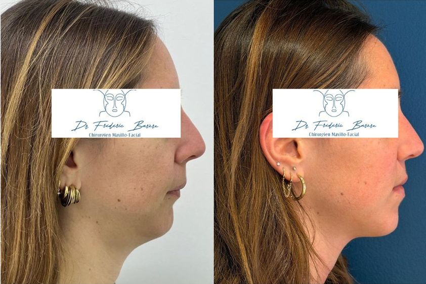 Chirurgie maxillo-faciale avant et après - 879956